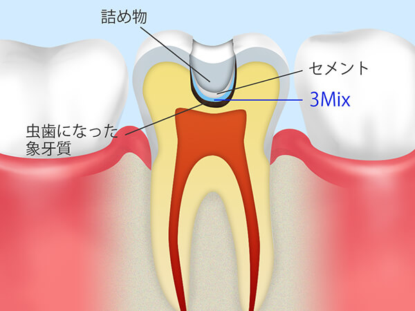 3Mix法