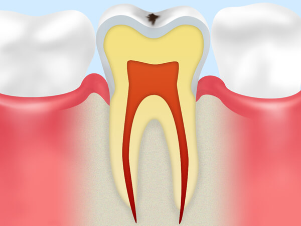 【ごく初期のむし歯】