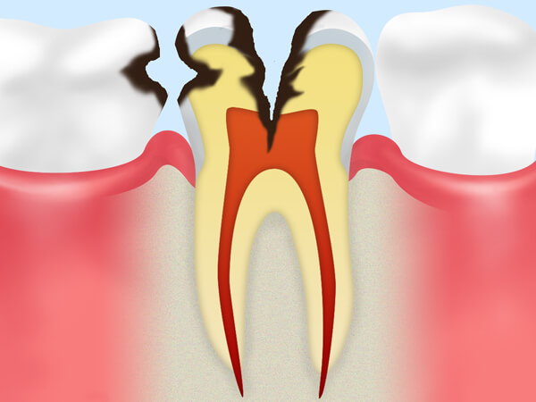 【神経まで達したむし歯】