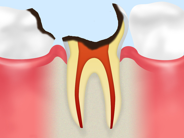 【歯根まで達したむし歯】