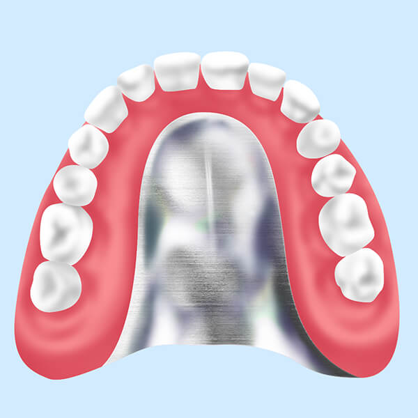 金属床義歯【自費治療】