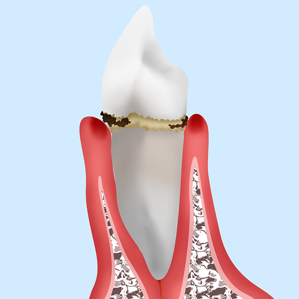 軽度歯周炎