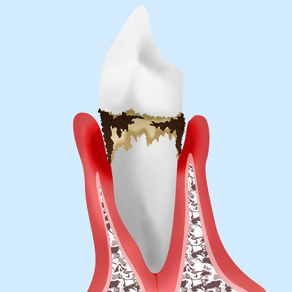 中等度歯周炎歯